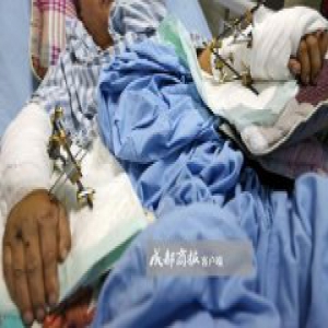 四川：饲养员遭大熊猫疯狂撕咬 手掌几乎被咬掉