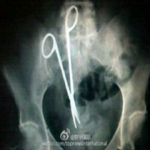 太吓人！越南医生把手术剪遗留患者腹中18年