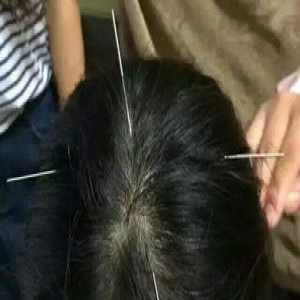 学以致用 医学生为复习自己扎针提神(图)