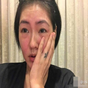 惊悚！小S和老公过情人节 喝酒过敏满脸红疹(图)